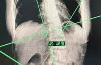 什么！脊柱矯正還能長高？